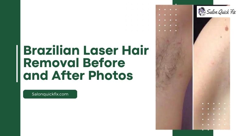 Brazilian Laser Hair Removal Before And After Photos Salonquickfix